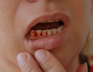 bleeding-gums-causes-and-treatment-1-300x235