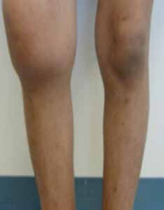 hemophilia-interview1-234x300